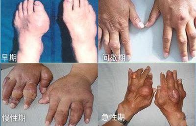 痛风不同时期.jpg