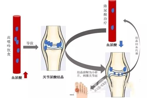 尿酸高q.jpg
