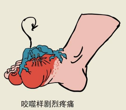 痛风病1.jpg